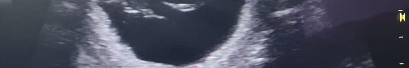 Ulatrschall_H-Wurf_Tingledales